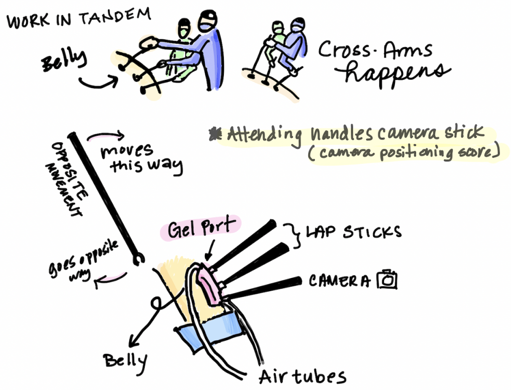 Sketch of how a surgeon team work together and the placement of laparoscopes into the body cavity.
